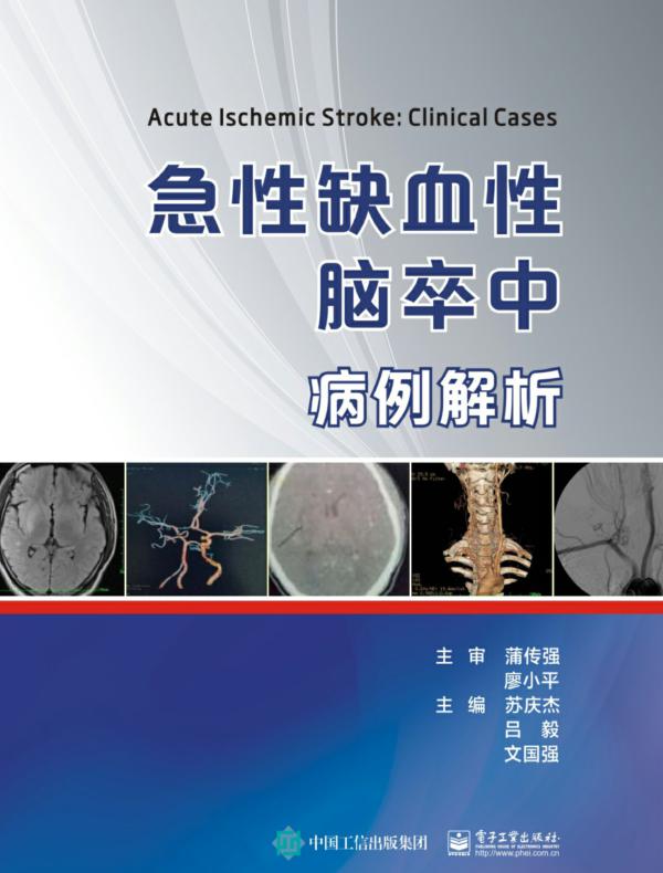 急性缺血性脑卒中病例解析